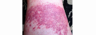 Symptoms of Golfer's Rash