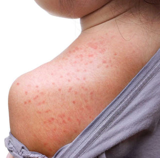 Are Your Kids Suffering with Itchy Red Bumps?