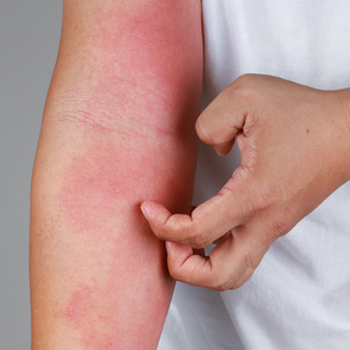 A close up of someone's arm where they are scratching. It can be seen that the arm is very red and inflamed and from Eczema