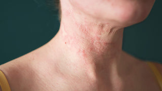 A close up photo of eczema on the neck